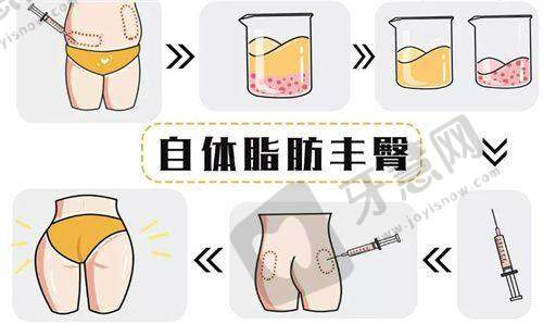 生物补片增大成效是终身的么？为啥不能“一劳永逸”？4个核心原因拆解