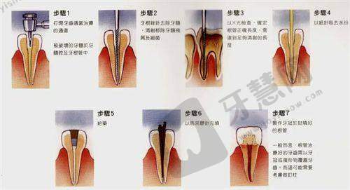 超薄全瓷贴面磨损牙齿缺点：磨除0.3mm牙釉质是否安心？医生这样说