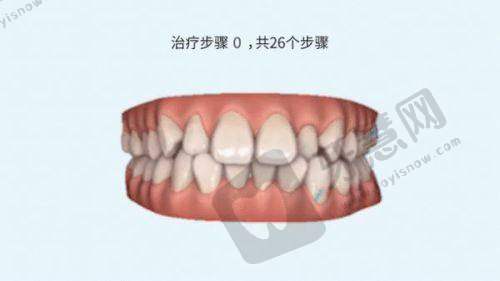 长春现代口腔快速正畸方案 29200 元起划算吗