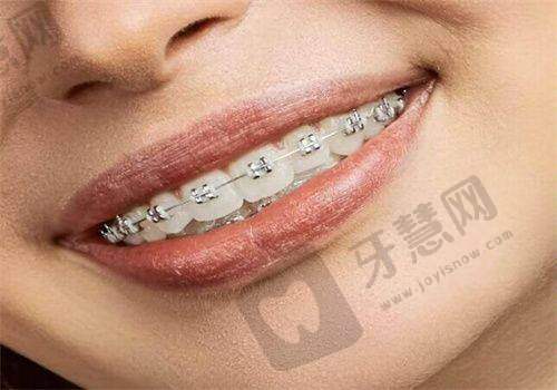 广东东莞口腔正畸重启方案 5200 元起：莞口与莞嘉口腔正畸亲民价，口碑连锁别错过