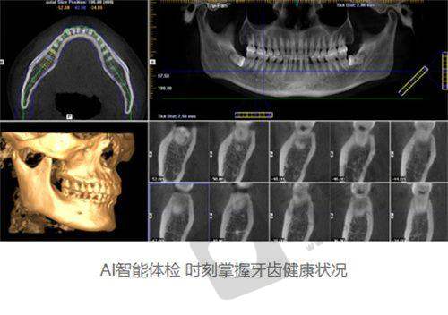 东莞虎门齿兰口腔以色列雅定种植牙7000元起预约方式
