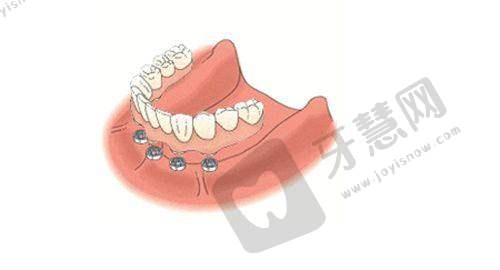 南宁蓝天口腔高龄半口种植 54200 元起，连锁品牌技术成熟且价格实惠值得选择