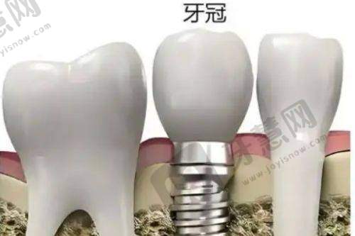 石家庄晋州源合口腔埋伏牙牵引正畸14200元起顾客实例