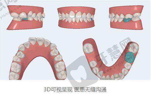 南宁蓝天口腔计算机导航种植5200元起怎么样预约