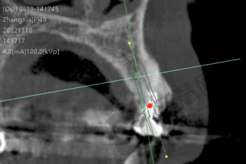 南宁蓝天口腔诺贝尔 Active 种植牙 18000 元起顾客实例