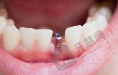 南宁同步口腔穿颧骨种植术 74200 元起项目简介