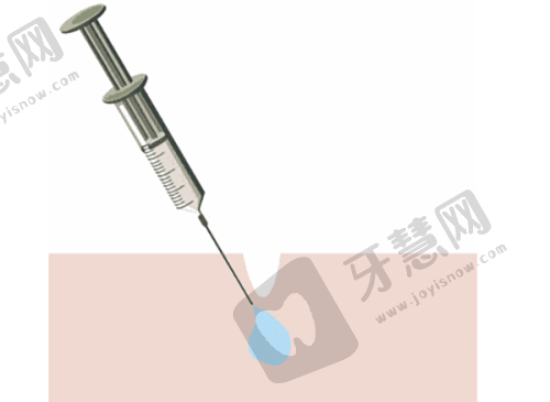 生物补片增大费用:材料不同,价差1万+