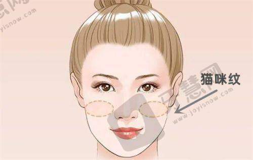 三、广州健丽去眼袋的术前准备与体验