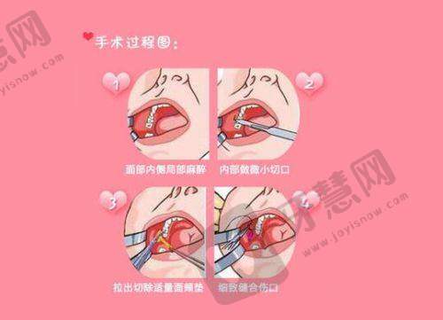 生物补片增大费用:别忽略“隐性消费”!这些钱你可能没算