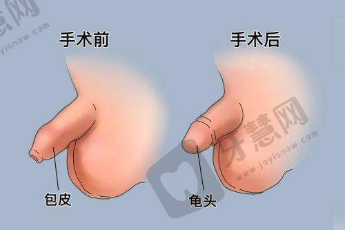 生物补片能让丁丁增粗几厘米？真实数据 + 实例对比，看完不纠结