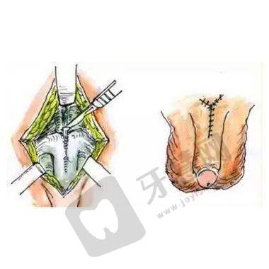 阴茎短小怎么办？2025最新延长增粗手术方案大揭秘，1对1专家在线解答