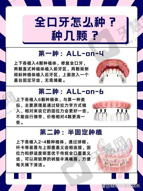 上海博名口腔微创即刻种植牙 12000 元起顾客实例