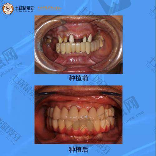 南宁蓝天口腔计算机导航种植5200元起，梁瑞院长高难度种植超千例，技术靠谱！