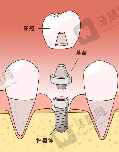 泉州石狮星雅口腔局部骨缺损种植 4500 元起，中等收费享先进技术与多样种牙方案