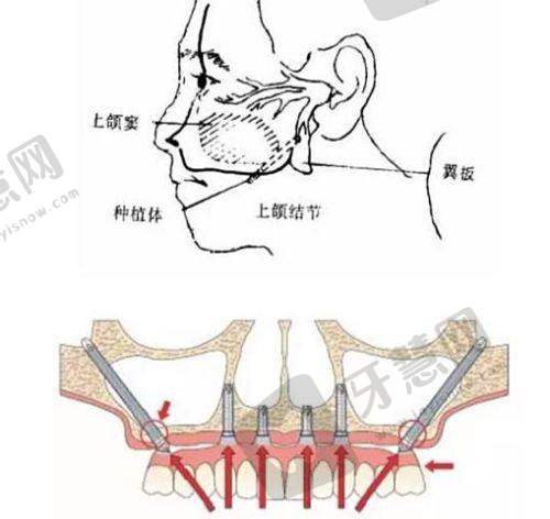 南宁蓝天口腔计算机导航种植5200元起顾客实例