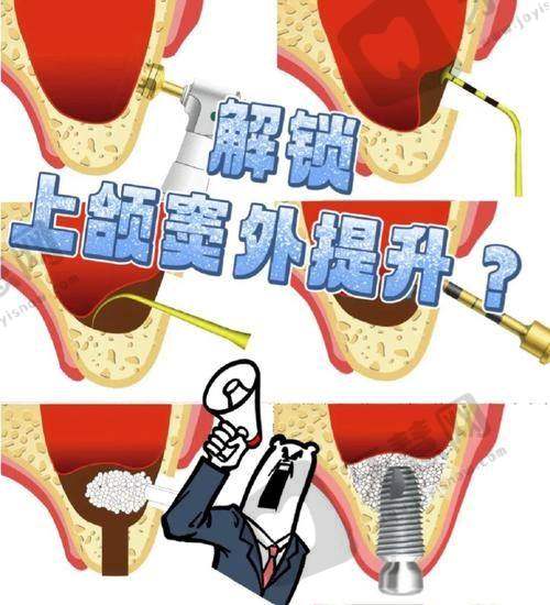 山西太原鼎植口腔上颌窦提升术4700元起怎么预约