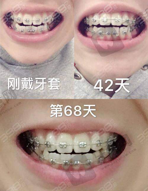 佛山登特口腔正畸支抗钉植入700元起，口碑医生黄倩矫正技术好，收费公开无乱价
