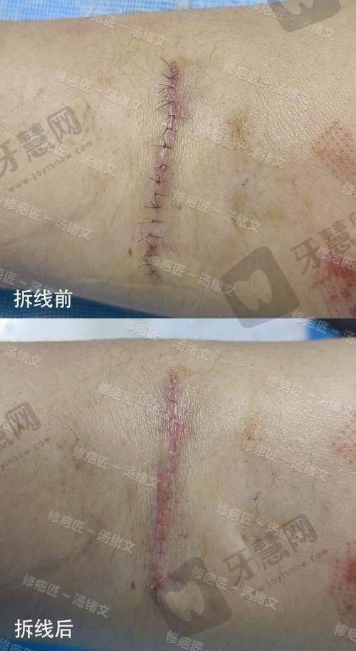 影响生物补片增粗疤痕大小的3大因素：选对了，疤痕就能“隐形”