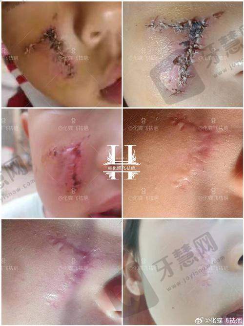 二、为什么有人说“补片消失了”？——3个让成效打折扣的“隐形杀手”