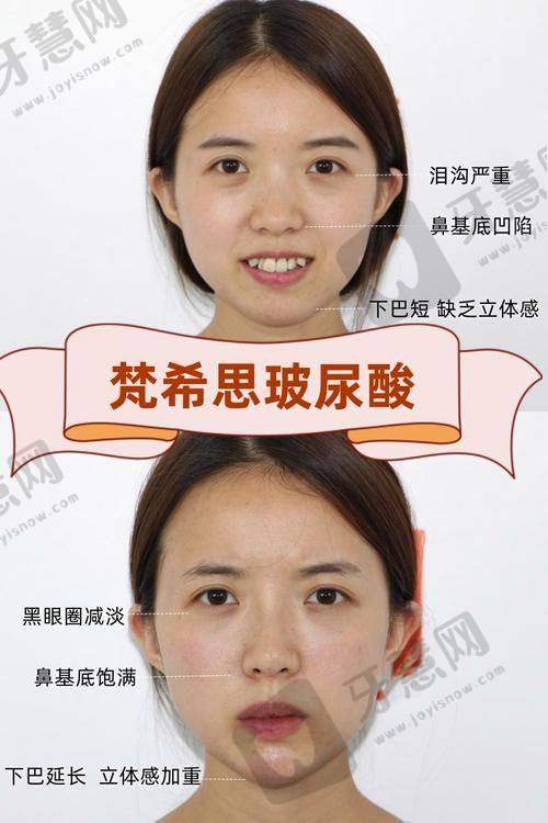 特色项目一览：注射塑形+光电抗衰，成效立竿见影