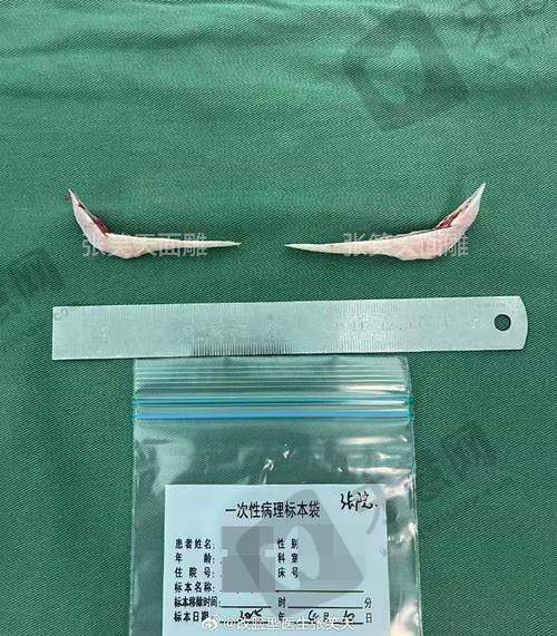 总结：重庆松山整形医院肖林医生技术好，项目全，选他不踩雷