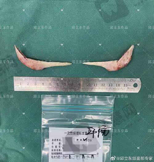 重庆松山医院整形项目盘点：不仅仅是磨骨