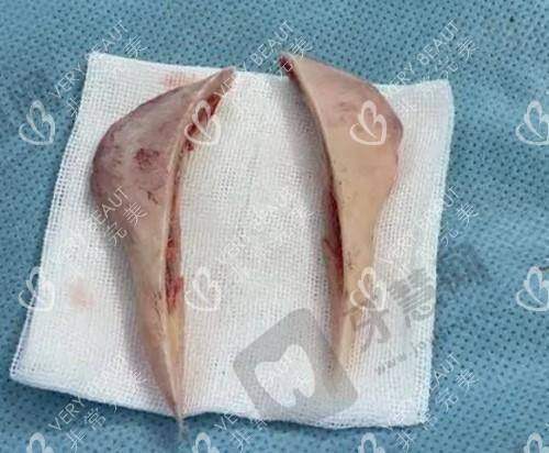 重庆松山整形医院下颌角技术好不好？肖林医生3D数字化手术受好评
