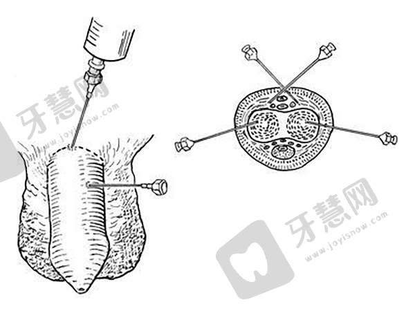 真皮补片增粗效果对比:5mm增粗是否真实?10年持久度与1cm增大案例揭秘