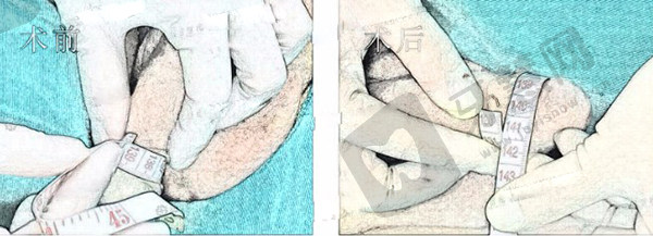 2025男性生物补片增大费用大揭秘：2万元起真实增粗2-3cm效果如何？