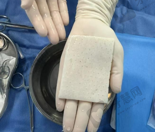 生物补片是什么材料做的？揭秘男性增粗手术效果与5大常见疑问