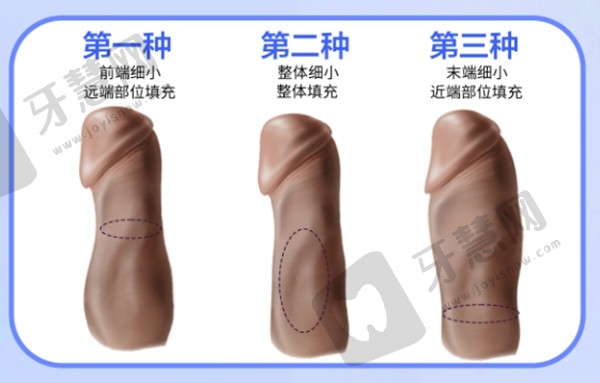 生物补片增粗疤痕会消失吗？2025年真实案例揭秘1-2cm增粗效果与术后护理