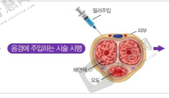 生物补片增粗能维持几年？专家解答：5~10年持久效果及手术利弊全解析