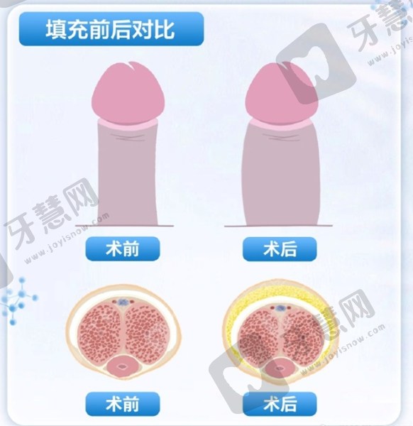 真皮补片增相费用多少？2025最新价目表曝光，增粗5mm能用10年值不值