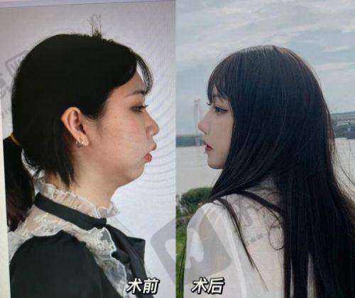 七、武汉艺星医疗美容医院乳房提升手术价格