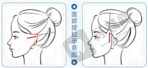 四、广州韩妃风筝小拉皮手术的技术创新
