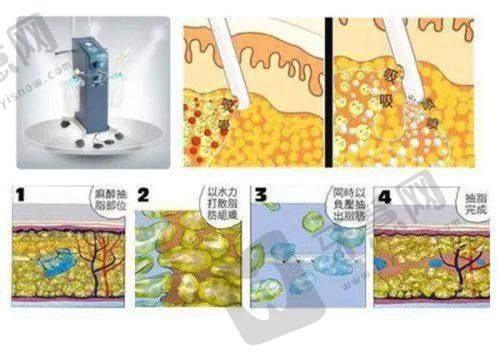 八、北京轻美颜眼袋提升医院价格表