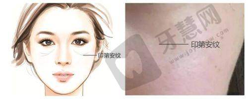 四、北京轻美颜眼袋提升医院项目特色
