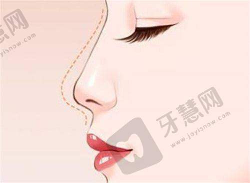 武汉华美付国友医生拉皮技术好，小拉皮3-4万元起/大拉皮4-6万元起效果自然损伤小复快