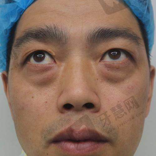 如何选择适合自己的去眼袋医生？