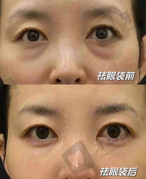 南京华美整形做眼袋好的医生推荐