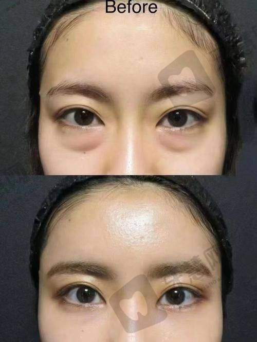 去眼袋术后护理指南