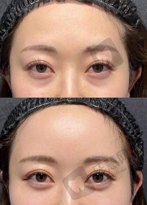南京华美整形医院哪个医生做眼袋技术好？980元祛眼袋是馅饼还是陷阱？
