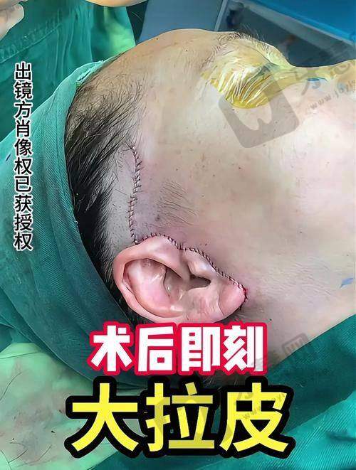 三、谢宏彬拉皮手术价格参考