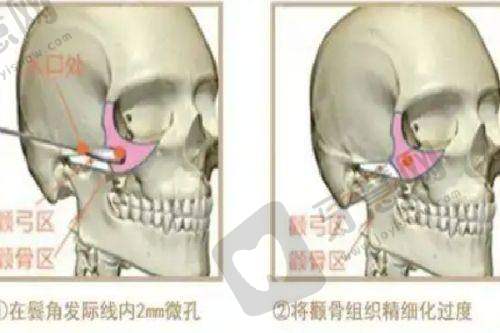 北京乳头内陷矫正排名前十——北京煤炭总医院