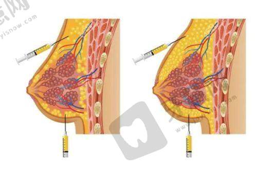 北京3D生物束带缩阴十大排医生院——北京美莱医疗美容医院