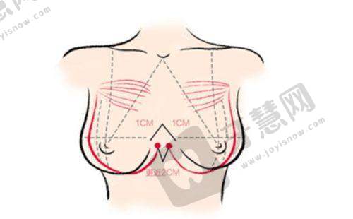 北京手术去副乳十大排医生院——北京世纪坛医院(整形科)