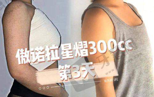 郑小红医生双眼皮手术价格