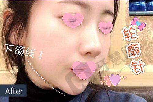 北京3D生物束带缩阴十大排医生院——北京华韩医疗美容医院