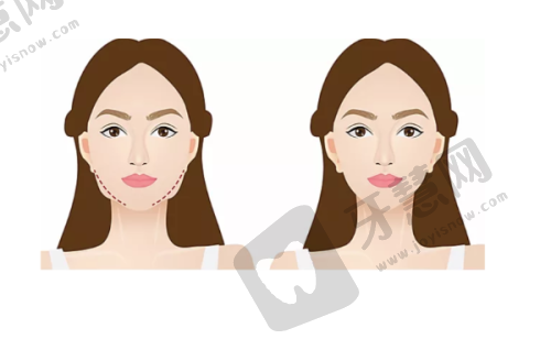 北京3D生物束带缩阴十大排医生院——北京画美医疗美容医院