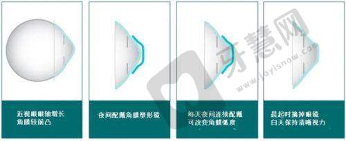 总结：天水爱尔眼科医院，是您放心的摘镜选择